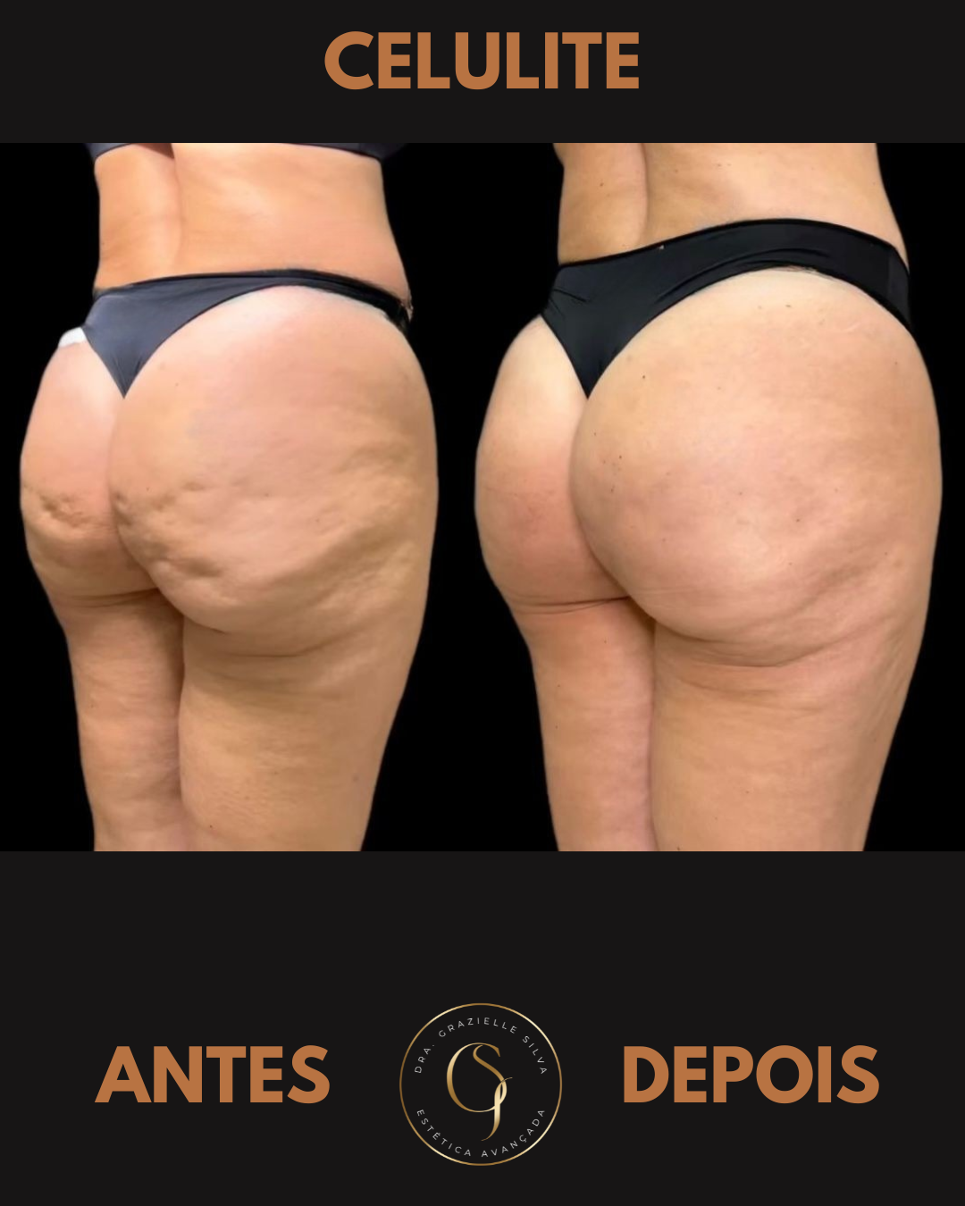 Resultado de Harmonização Glútea